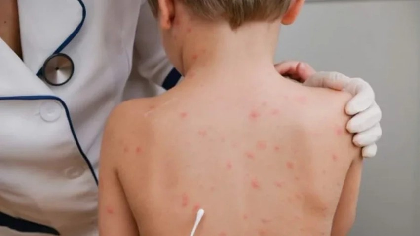 Përhapja e fruthit në vend: Tre pacientë të shtrirë në Klinikën Infektive, mjekët bëjnë thirrje për vaksinim