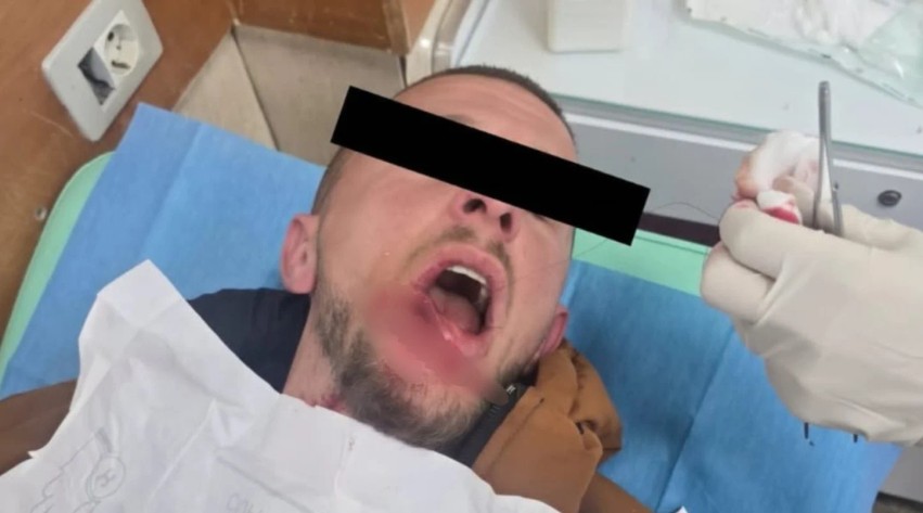“Mjaft me plumbat ndaj të rinjve” – Berisha publikon pamjet e protestuesit 21-vjeçar të plagosur rëndë në fytyrë