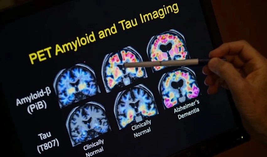 Shpresa të reja kundër Alzheimerit: Molekula eksperimentale që po befason shkencëtarët