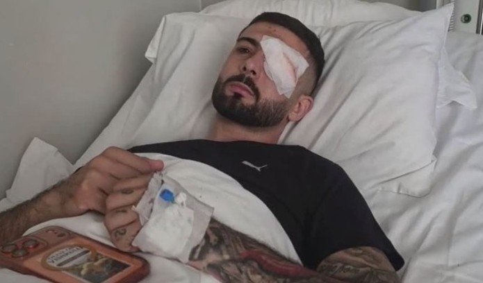 Ndërhyrje e suksesshme në Romë: Erjon Vishkulli i shpëton rrezikut për humbjen e syrit pas plagosjes nga policia